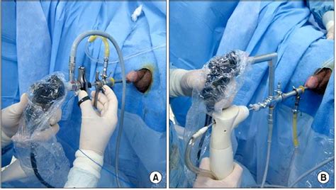 Technical Aspects Of Holmium Laser Enucleation Of The Prostate For