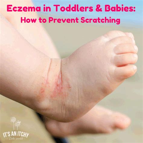 Eczema In Toddlers And Babies How To Prevent Scratching And Soothe Itchy Skin