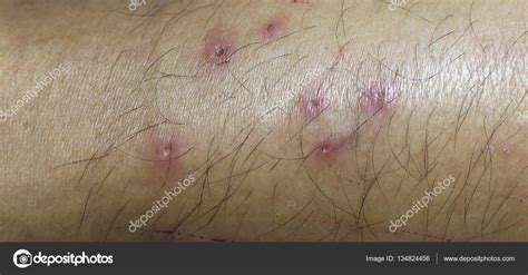 Úlceras En Las Piernas Gangrena Causada Por Picaduras De Mosquitos