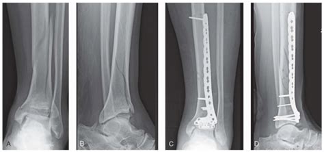 Ankle And Pilon Fractures Musculoskeletal Key