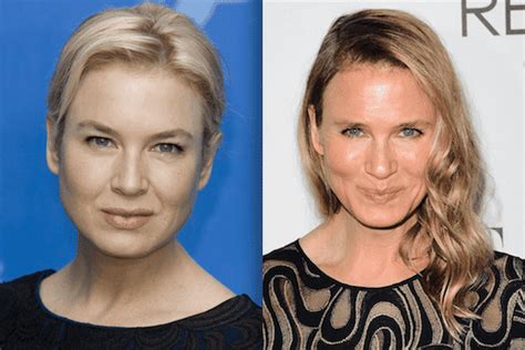 Renee Zellweger Before And After Surgery
