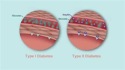 We have the resources to help you thrive. What's the Difference Between Type 1 and Type 2 Diabetes ...