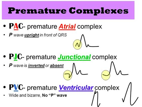 Premature Atrial Contractions Vs Premature Ventricular Contractions