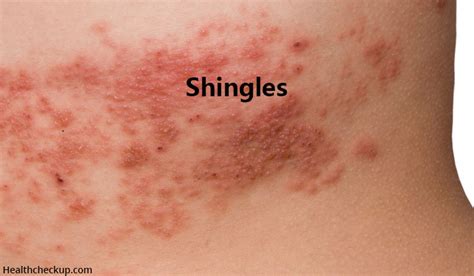 Early Stage Herpes Rash On Arm How Long Does Shingles Last Timeline