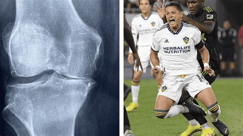 rotura de ligamento cruzado anterior lesión de chicharito en la rodilla
