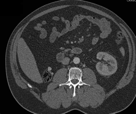 Stool In Colon Simulates Recurrent Renal Cell Carcinoma In Right Renal