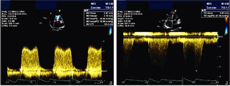 Transthoracic Echocardiogram Demonstrating A Severe Mitral Stenosis Download Scientific