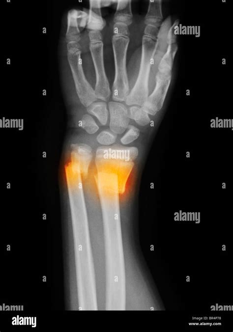 Distal Radius And Ulna Fracture With Displacement Stock Photo Alamy