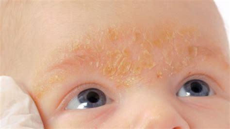 Infantile Seborrhoeic Dermatitis Cradle Cap Fitderma