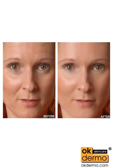 These cosmetic procedures will help you whiten your skin. Antioxidant For Ageing Skin Vitamin C 15% Serum VC-15 ...