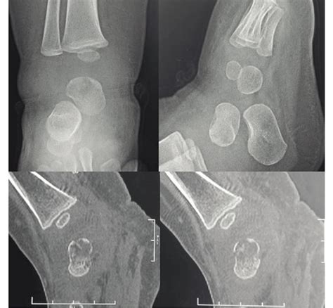 Ankle Imaging X Ray Of The Ankle Showing A Lytic Lesion Of The Talus