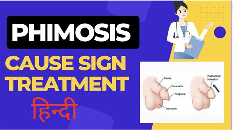 Phimosis Phimosis In Hindi Causes And Risk Factorssymptoms