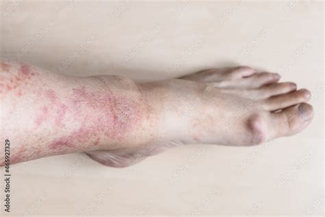 Sample Of Allergic Contact Dermatitis Male Shin With Redness And