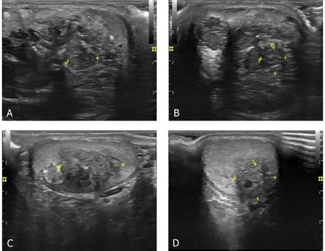Ultrasound Pictures Of The Testicular Adrenal Rest Tumors Upper