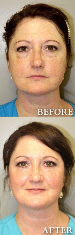 Cool Peel Laser Bopp Dermatology Facial Plastic Surgery