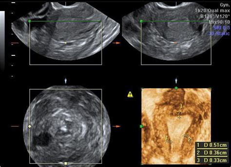 3d Ultrasound Assessment Of Endometrial Junctional Zone Anatomy As A