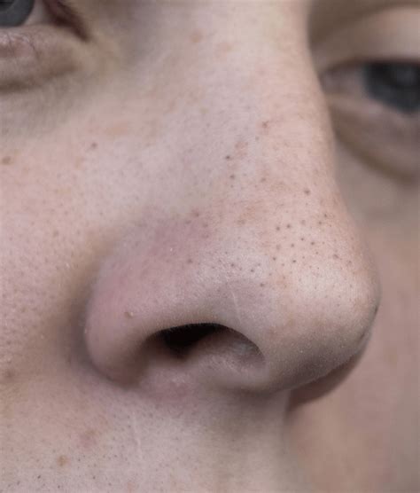 What Do Enlarged Pores Look Like Ar