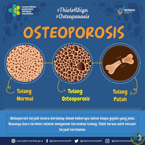 Apa Penyebab Terjadinya Osteoporosis Meteor