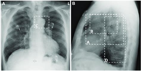 Location Of Aortic Calcification On Chest X Ray A And B The