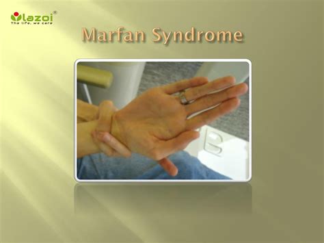 PPT Marfan Syndrome Causes Symptoms Daignosis Prevention And