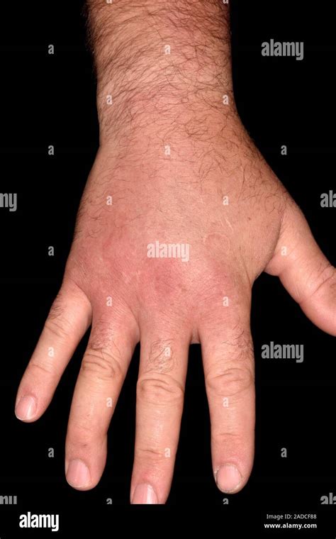 Wasp Sting Swelling In The Hand Of A 44 Year Old Man Caused By A Wasp Sting The Venom In Wasp