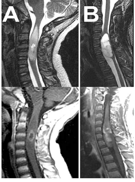 Detection Of Spinal Cord Tumor Related Edema On Mri Examples Of The