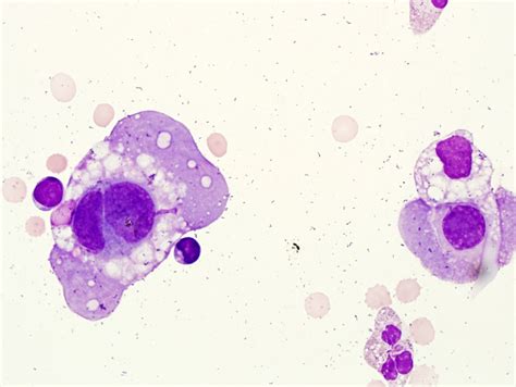 Reactive Mesothelial Cells With Atypia Mesothelial Cells May Contain