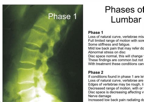 Lumbar Phases Spinal Degeneration Poster 18 X 24 Chiropractic