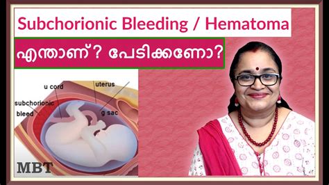 Subchorionic Hematomableeding In Pregnancy What Is It Should You Be