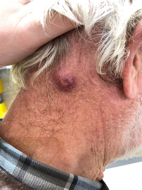My Dad Has A Sebaceous Cyst On His Neck He Went To The Gp