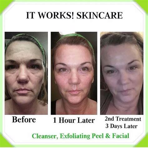 before and after picture shows results from it works cleanser exfoliating peel and facial