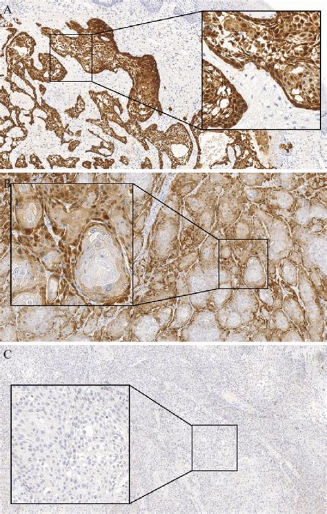 Immunohistochemical Staining Of P16 A Positive Sample In The Detail