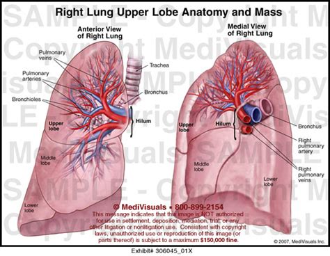Medivisuals Right Lung Upper Lobe Anatomy And Mass Medical Illustration