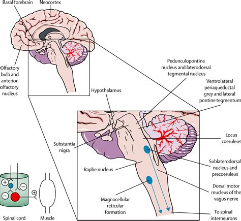 Idiopathic Rem Sleep Behaviour Disorder In The Development Of Parkinsons Disease The Lancet