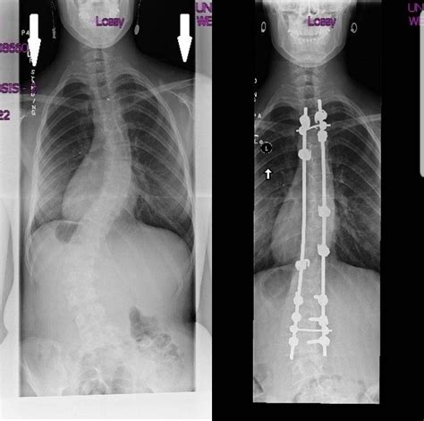 Xrays Before And After Spinal Fusion Surgery For Scoliosis Rmedizzy