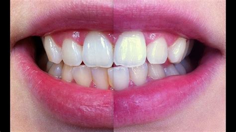 That's why it is better to use it yourself to find out the effectiveness of a product or treatment. How to whiten your teeth at home quickly, (20 minutes ...