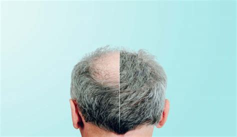 Alopecia Di Cosa Si Tratta E Come Intervenire