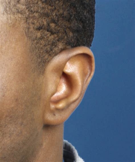 Scapha Reduction Macrotia 9 World Expert In Making Ears Smaller