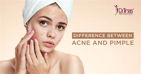 Acne Vs Pimples Do You Know The Differences Skin Solutionz