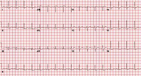 Stable ischemic heart disease - Symptoms, diagnosis and treatment | BMJ