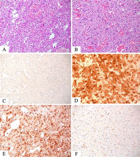Tfeb Rearranged Renal Cell Carcinoma Made Up Of Round Cells With