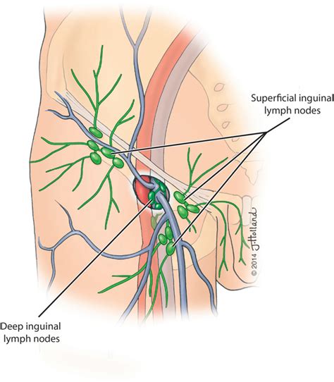 Figure From The Surgical Anatomy Of The Inguinal Lymphatics Semantic Scholar
