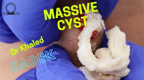 Massive Neck Cyst Removal Dr Khaled Sadek LipomaCyst Com YouTube