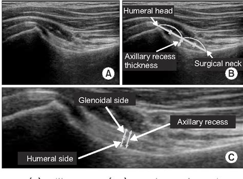 Figure 3 From Ultrasonographic Measurement Of The Thickness Of Axillary