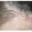 Is This Dry Scalp Psoriasis Or Something Else A Photo Of The 