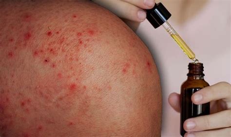 Eczema Treatment Prevent Dry Skin With A Sunflower Oil Moisturiser Or