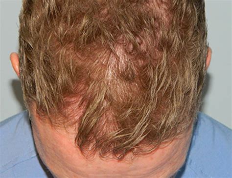 Patient 133066269 Hair Transplant Smartgraft Before And After Photos