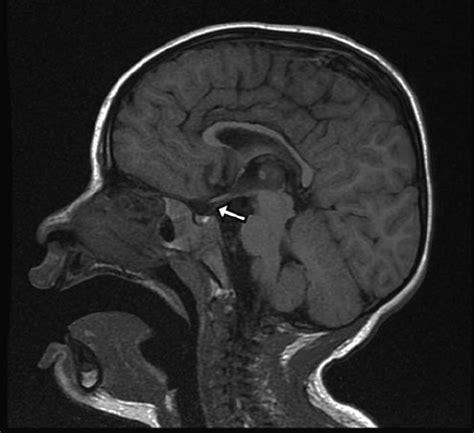 Sagittal T1 Weighted MRI Of A Patient With A Postfixed Chiasm And