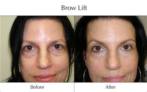 Please enjoy the following before and after pictures of brow lifts. Cosmetic Plastic Surgery Centre