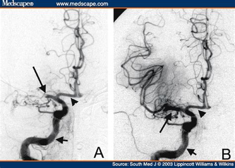 Carotid doppler echocardiogram cardiac monitoring cerebral angiogram. Figures